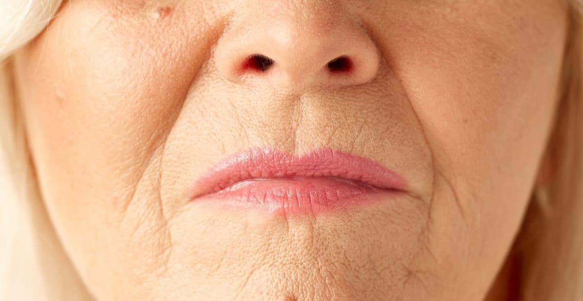 Ce chirurgien est formel : la
“rhytidectomie” est la seule solution permanente et efficace pour
effacer les rides autour de la bouche