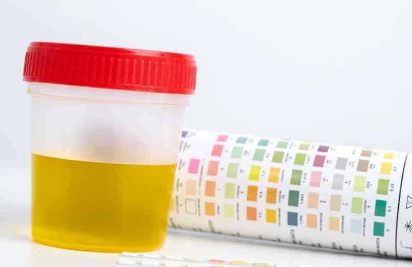 Couleur des urines et insuffisance rénale : que signifient les teintes inquiétantes et que faire ? Lulu Nature