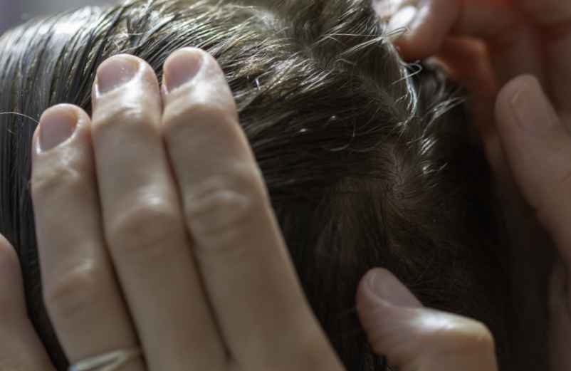 Bouton dans le cuir chevelu qui gratte : causes et solutions magiques-Lulu Nature