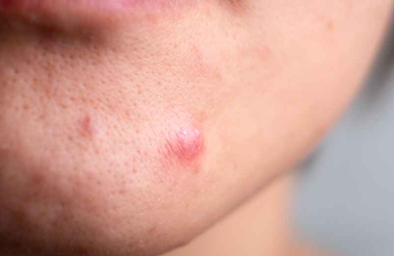 Bouton sur le visage qui ne part pas depuis des mois : que faire ?-Lulu Nature