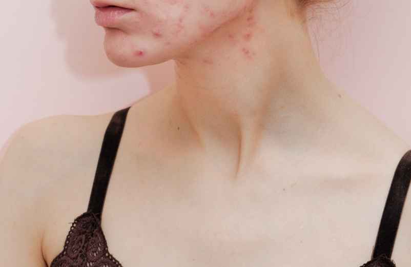 Comment prévenir l’apparition de boutons et de l'acné à l’âge adulte ?-Lulu Nature