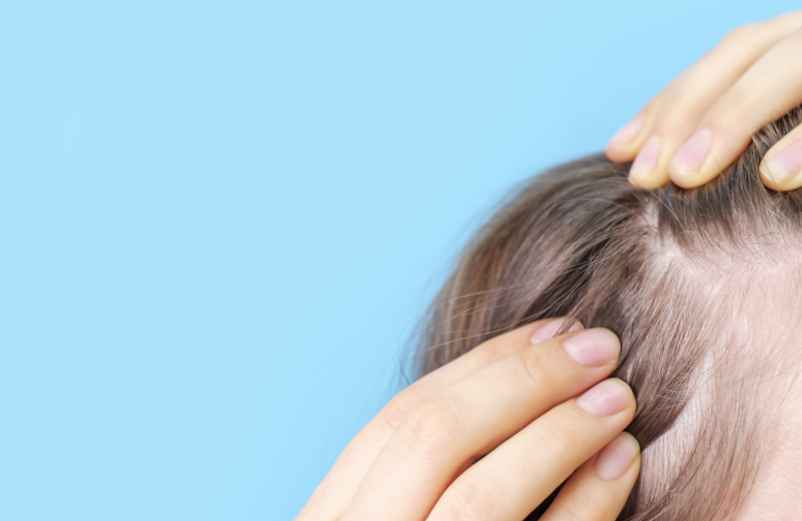 Quelles saines habitudes pour se débarrasser des boutons dans le cuir chevelu ?-Lulu Nature