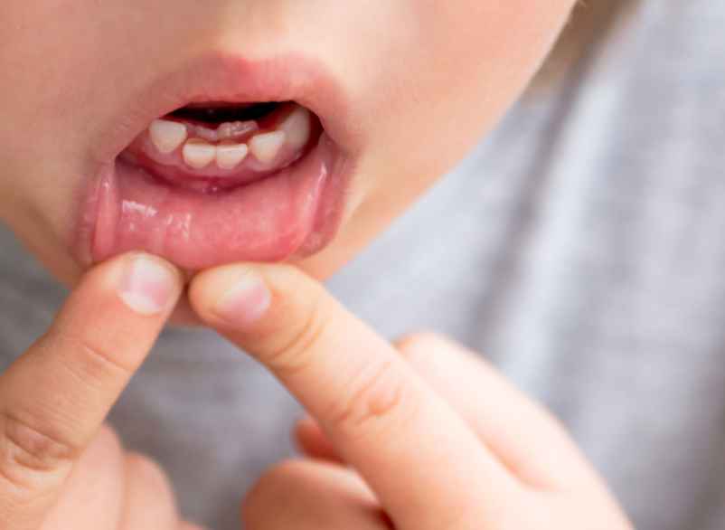 Aphtes : comment les soigner naturellement et soulager la douleur ?-Lulu Nature