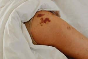 Remède de grand-mère pour enlever un hématome plus vite-Lulu Nature