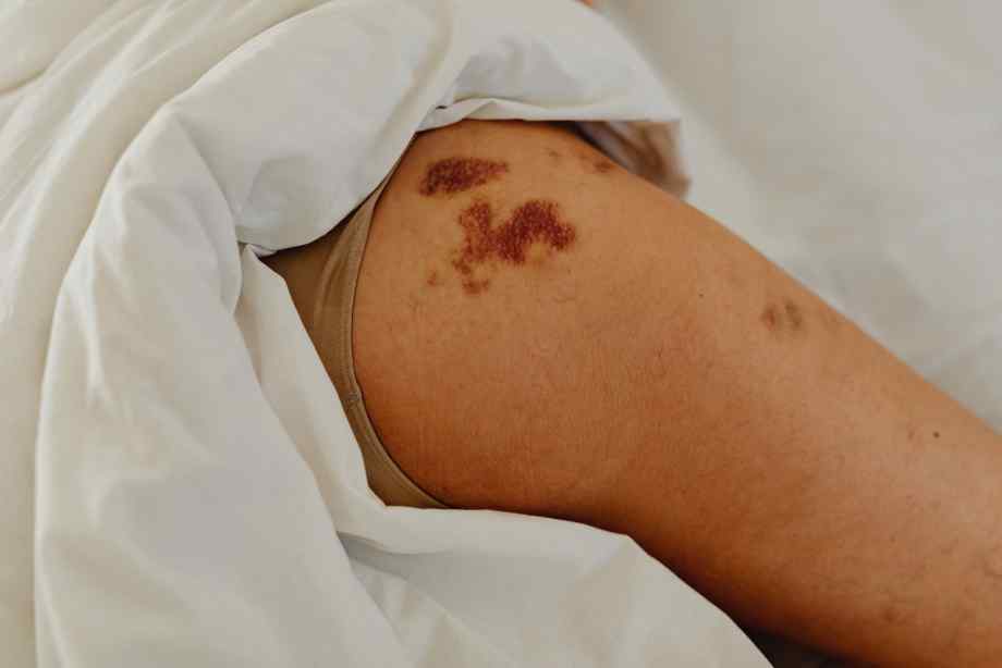 Remède de grand-mère pour enlever un hématome plus vite-Lulu Nature